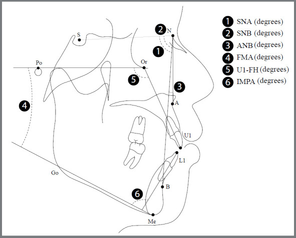 Dentoalveolar changes observed after the use of customized bonded Shark-Tooth-Like Spurs (JAWs) in adult patients with anterior open bite.