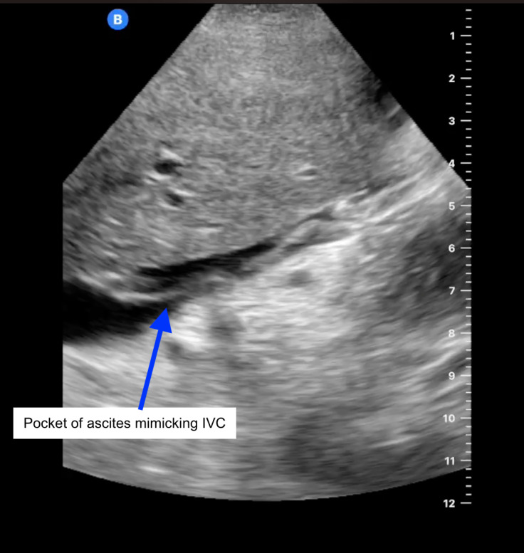 Missing Inferior Vena Cava on POCUS: A Case of Left-Sided IVC with Azygos Continuation.