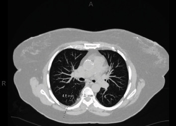 A PAX-8-Positive Female Urethral Adenocarcinoma, Intestinal-Type: A Case Report with Diagnostic Challenges and a Review of the Literature.