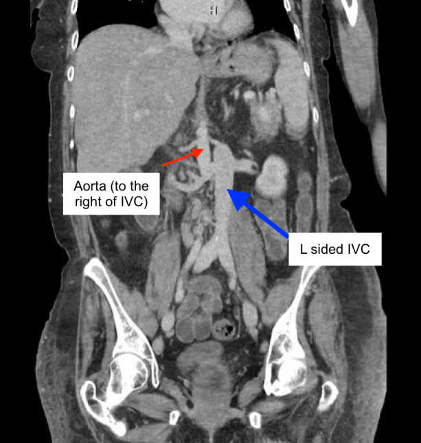 Missing Inferior Vena Cava on POCUS: A Case of Left-Sided IVC with Azygos Continuation.