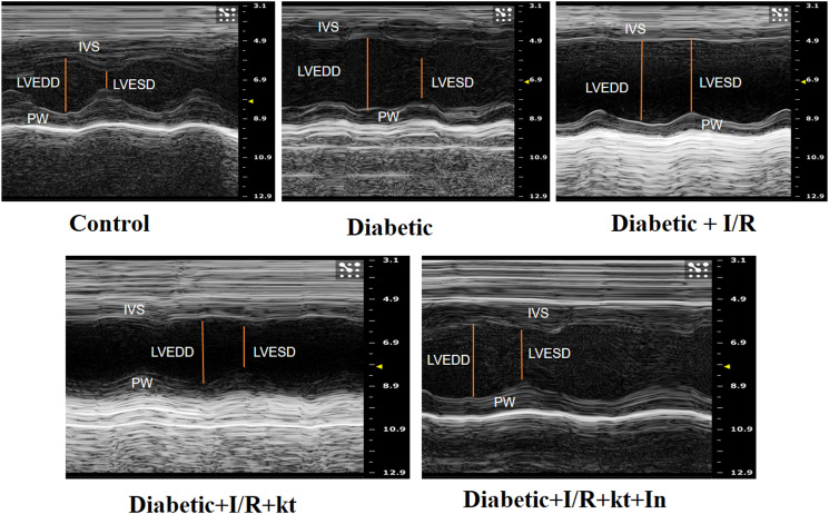 Ischemia reperfusion myocardium injuries in type 2 diabetic rats: Effects of ketamine and insulin on LC3-II and mTOR expression.