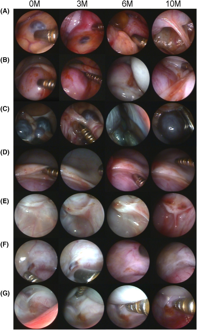 Impact of administering umbilical cord-derived mesenchymal stem cells to cynomolgus monkeys with endometriosis.