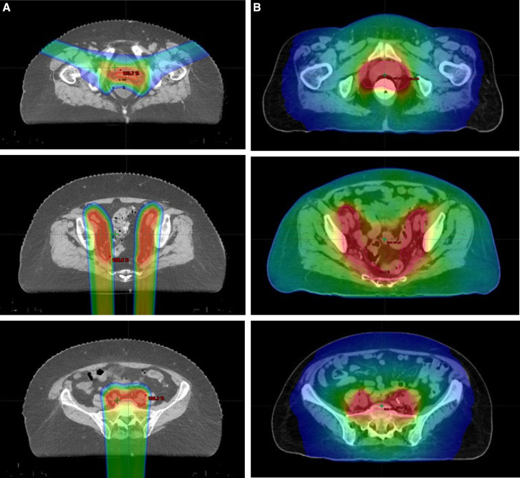 Outcomes of Proton Beam Therapy Compared With Intensity-Modulated Radiation Therapy for Uterine Cancer.