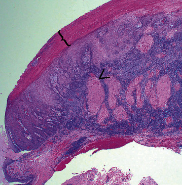 Limbal Squamous Cell Carcinoma in a Black Baldy Cow: Case Report and Surgical Treatment.