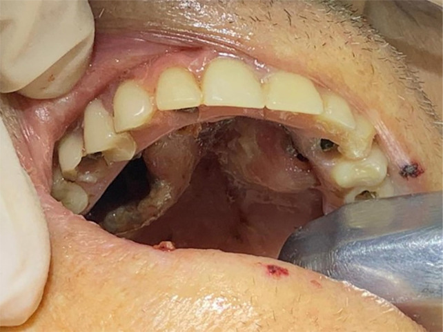 Treatment of oral myiasis in a patient with implant-supported fixed prosthesis.