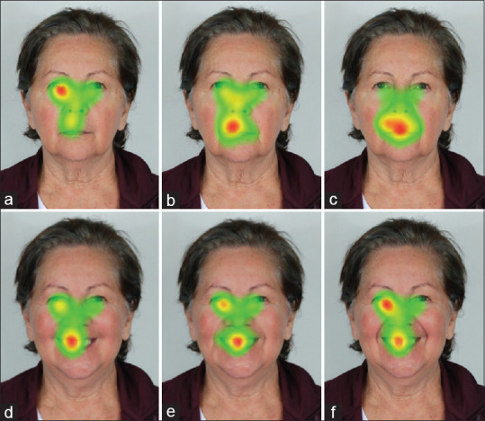 The Esthetics of the Nasolabial Fold and Age in the Elderly Via Eye-Tracking.