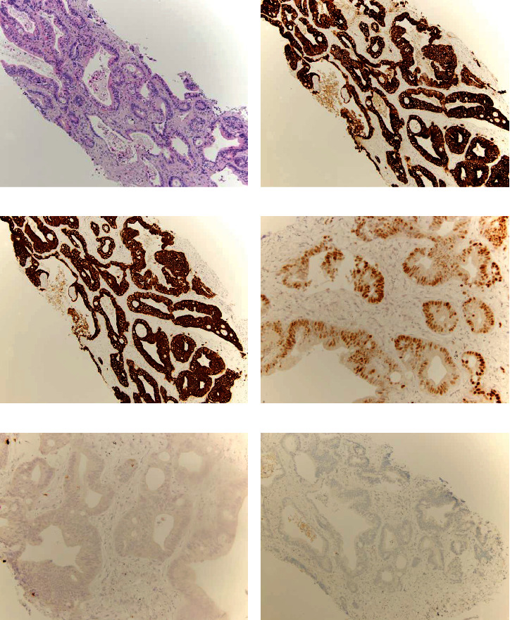 A PAX-8-Positive Female Urethral Adenocarcinoma, Intestinal-Type: A Case Report with Diagnostic Challenges and a Review of the Literature.