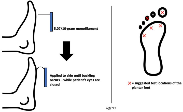 Fractures and dislocations of the foot and ankle in people with diabetes: a literature review.