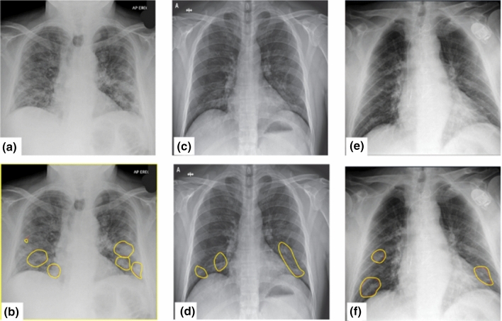 A smart healthcare framework for detection and monitoring of COVID-19 using IoT and cloud computing.