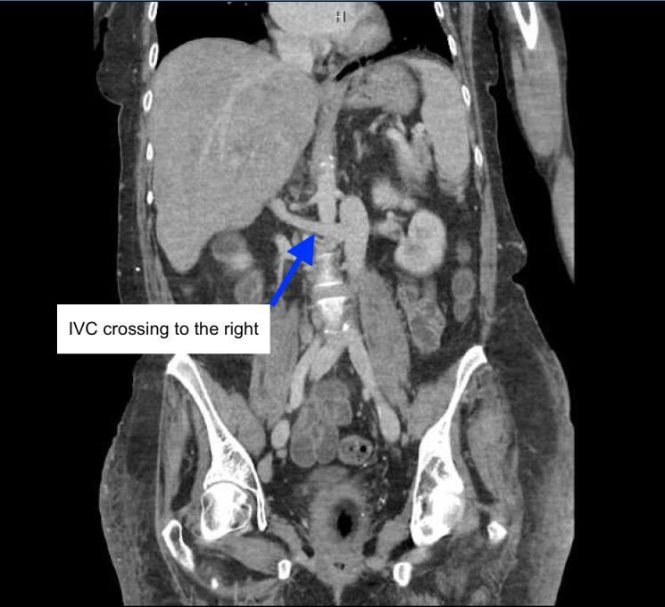 Missing Inferior Vena Cava on POCUS: A Case of Left-Sided IVC with Azygos Continuation.