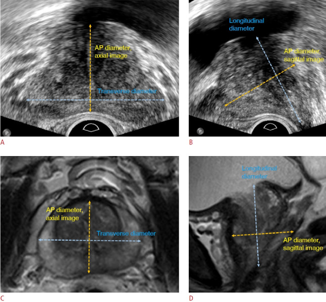 Prostate gland volume estimation: anteroposterior diameters measured on axial versus sagittal ultrasonography and magnetic resonance images.