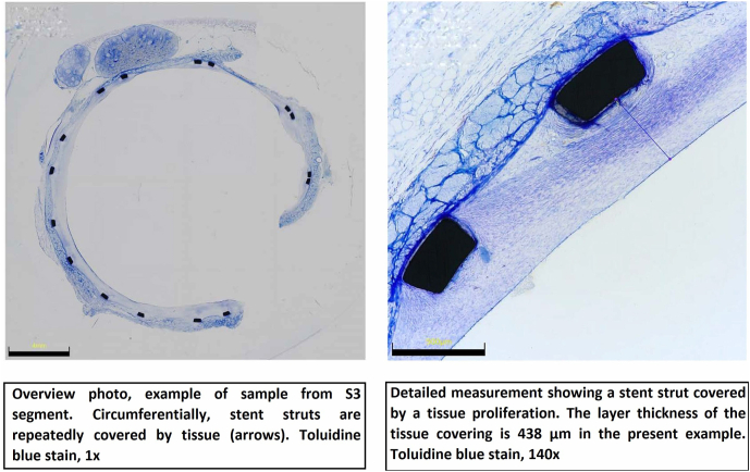 Evaluation of safety and performance of a new prototype self-expandable nitinol venous stent in an ovine model