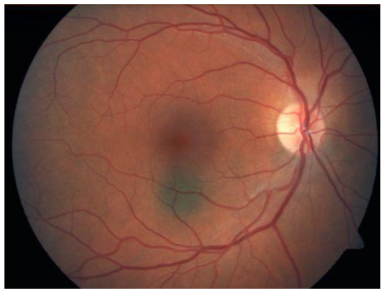 Choroidal Melanoma: A Mini Review.