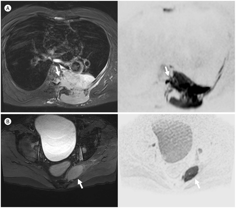 [Clinical Application and Limitations of Myeloma Response Assessment and Diagnosis System (MY-RADS)].