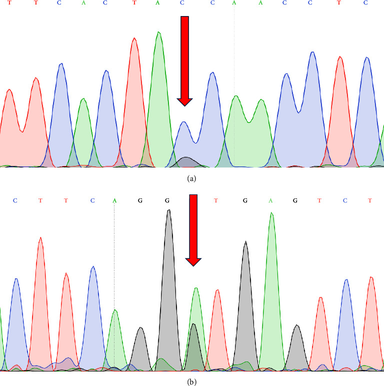 Coinheritance of the c.-19 G > C and c.315 + 1 G > A Variants in the <i>β</i>-Globin Gene Leads to Thalassemia Disease: A Report from the North of Iran.