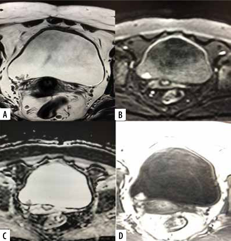 Diagnostic performance of multiparametric MRI based Vesical Imaging-Reporting and Data System (VI-RADS) scoring in discriminating between non-muscle invasive and muscle invasive bladder cancer.