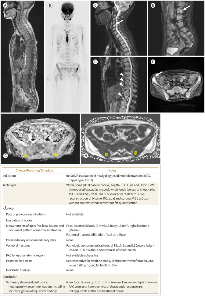 [Clinical Application and Limitations of Myeloma Response Assessment and Diagnosis System (MY-RADS)].