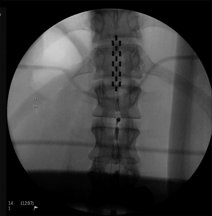 Spinal cord epidural stimulation for motor and autonomic function recovery after chronic spinal cord injury: A case series and technical note.