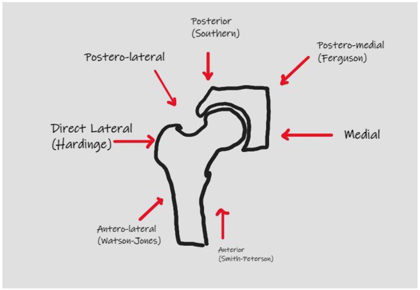 Surgical Approaches in Total Hip Arthroplasty.