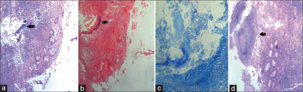 Appendiceal actinomycosis presenting as acute appendicitis: A diagnostic and therapeutic challenge.