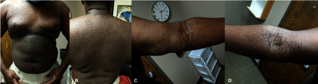 A Case for Doxycycline as an Effective Treatment for Confluent and Reticulated Papillomatosis (CARP).