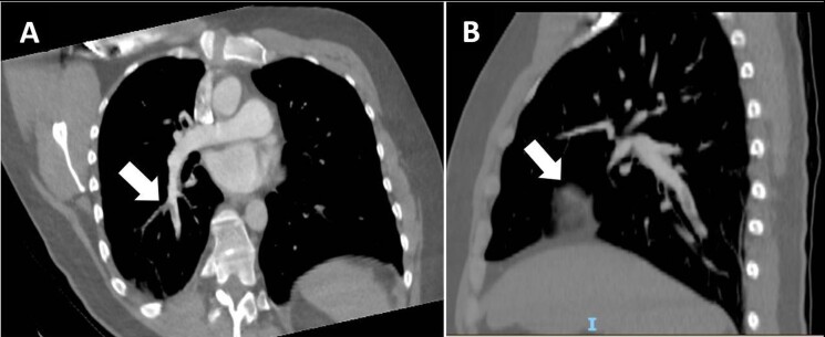 Acute pulmonary embolism as a complication in a young male patient with a left popliteal venous aneurysm.