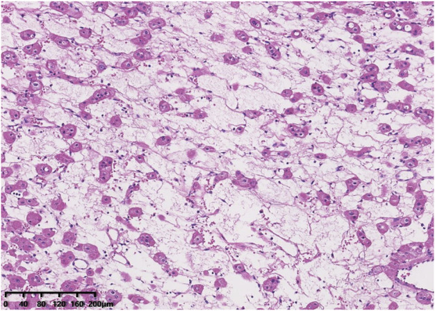 Low-grade oncocytic tumour (LOT) of the kidney is characterised by GATA3 positivity, FOXI1 negativity and mTOR pathway mutations.