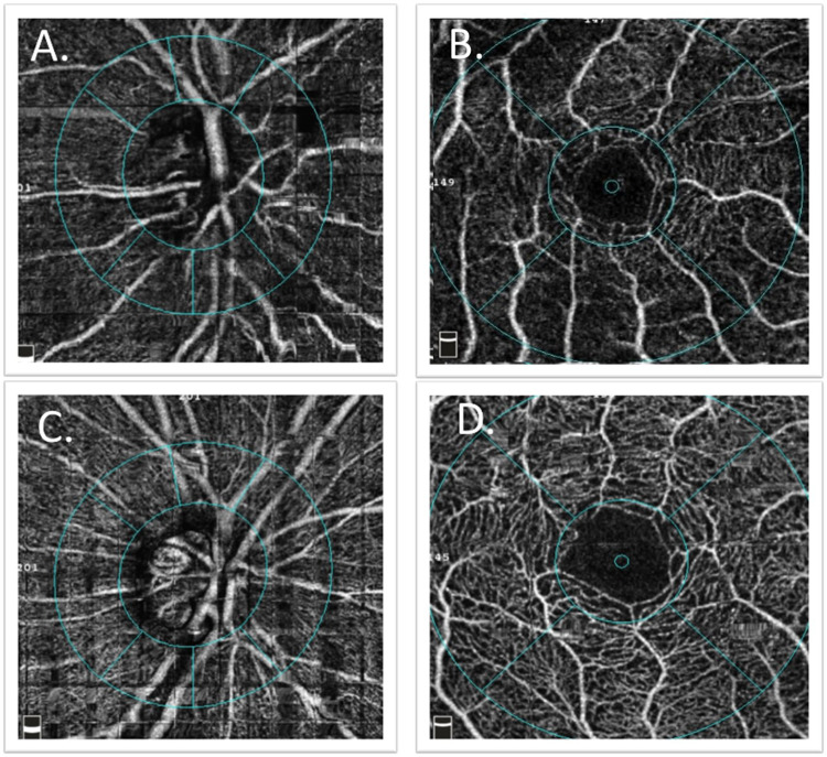 Changes in Ocular Biomarkers from Normal Cognitive Aging to Alzheimer's Disease: A Pilot Study.