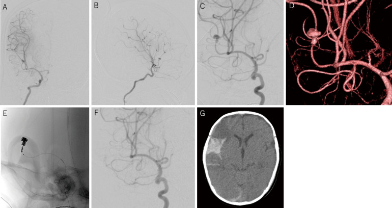 Ruptured Middle Cerebral Artery Aneurysm in an Infant: Case Report and Literature Review.