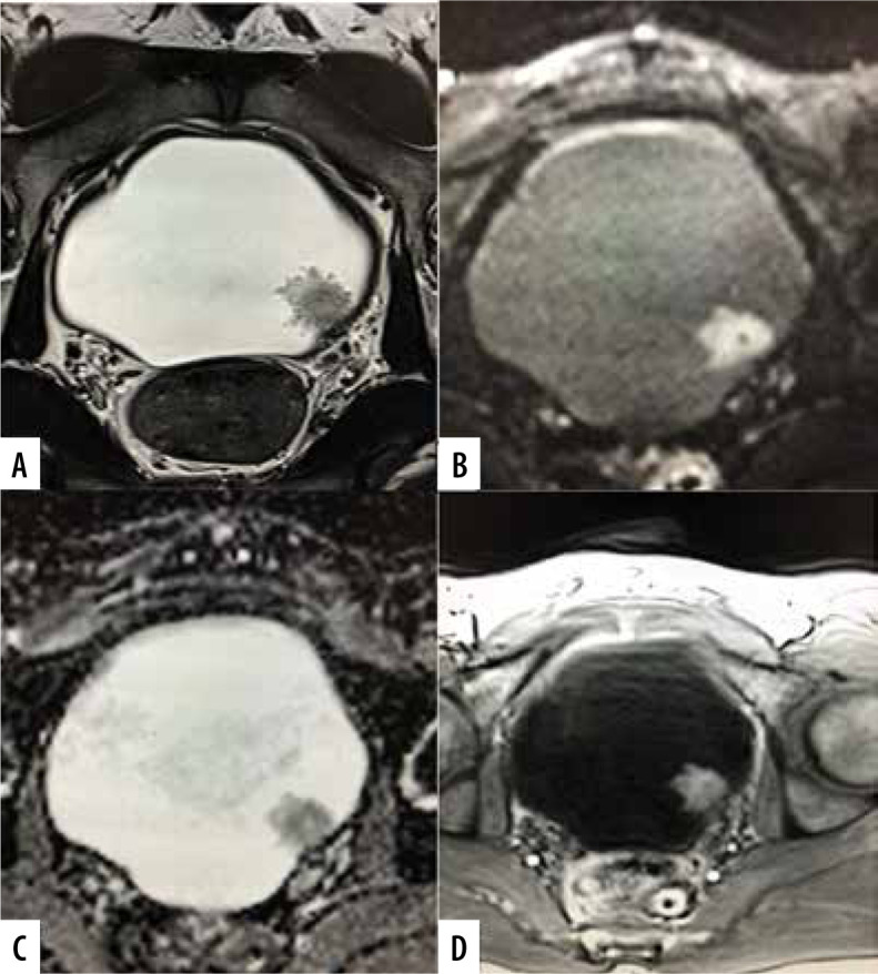 Diagnostic performance of multiparametric MRI based Vesical Imaging-Reporting and Data System (VI-RADS) scoring in discriminating between non-muscle invasive and muscle invasive bladder cancer.