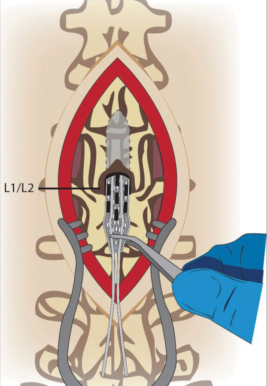 Spinal cord epidural stimulation for motor and autonomic function recovery after chronic spinal cord injury: A case series and technical note.