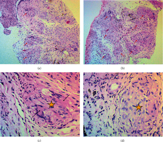 Exertional Dyspnea Incidentally Diagnosed as Sarcoidosis: A Teaching Hospital Experience.