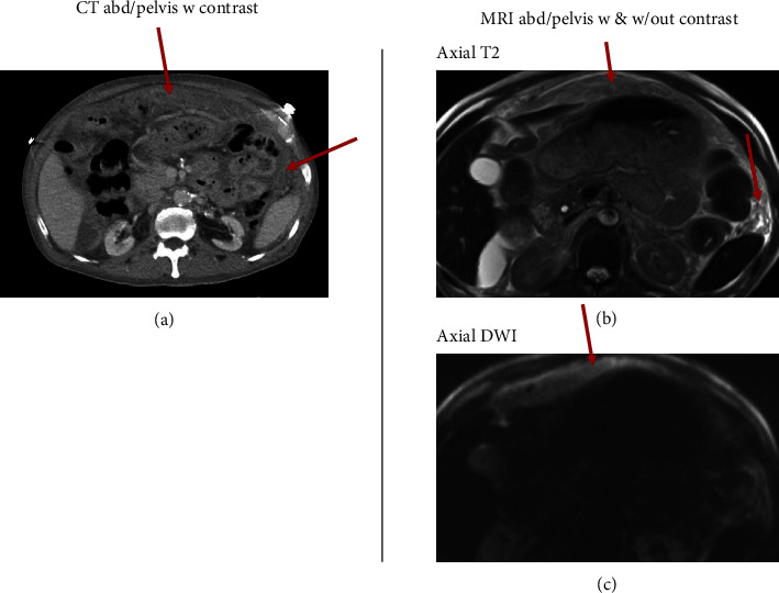 Disseminated Peritoneal Tuberculosis Initially Misdiagnosed as Nephrogenic Ascites.