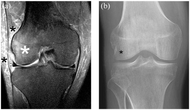 Role of imaging for eligibility and safety of a-NGF clinical trials.