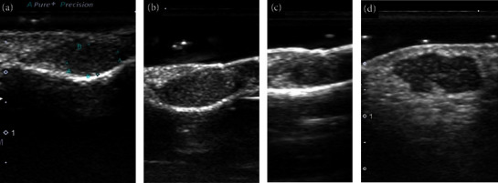 Ultrasonographic Characteristics in the Fingers and Other Superficial Glomus Tumours.