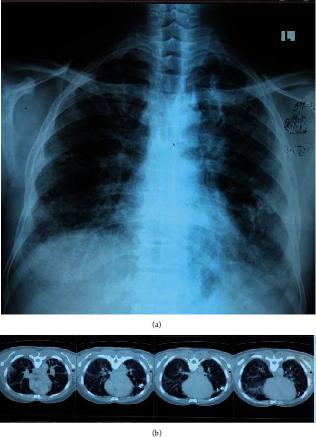 Exertional Dyspnea Incidentally Diagnosed as Sarcoidosis: A Teaching Hospital Experience.