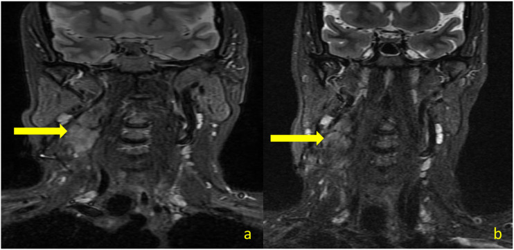 Recurrent Aggressive Fibromatosis Coexisting With Papillary Carcinoma Thyroid - Case Report.