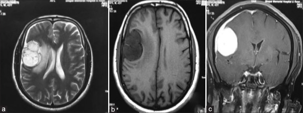 Microcystic Meningioma - A Diagnostic Dilemma During Intraoperative Squash Smear Study.