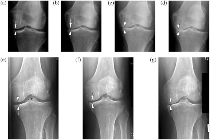 Role of imaging for eligibility and safety of a-NGF clinical trials.