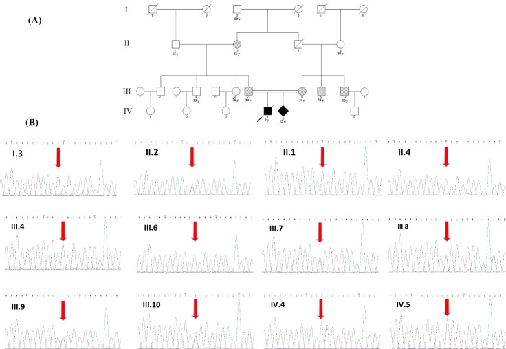 Homozygous mutation in <i>CSF1R</i> causes brain abnormalities, neurodegeneration, and dysosteosclerosis (BANDDOS).