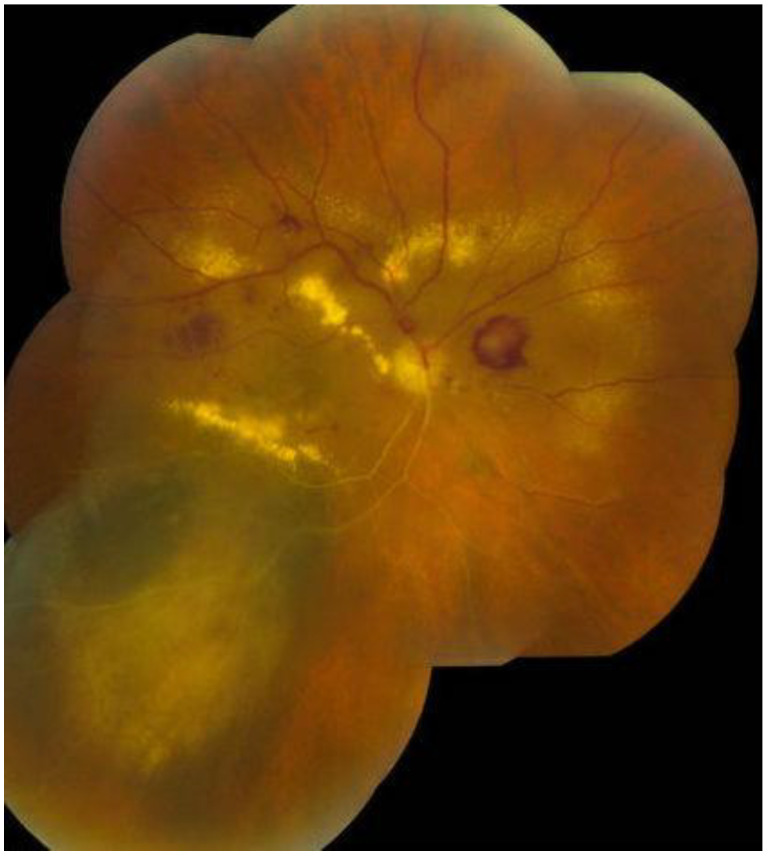 Choroidal Melanoma: A Mini Review.