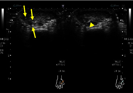 Ultrasonographic Characteristics in the Fingers and Other Superficial Glomus Tumours.