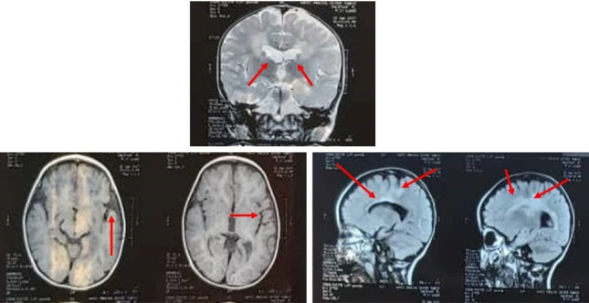 Homozygous mutation in <i>CSF1R</i> causes brain abnormalities, neurodegeneration, and dysosteosclerosis (BANDDOS).