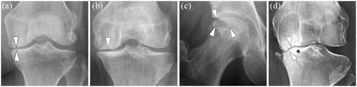 Role of imaging for eligibility and safety of a-NGF clinical trials.