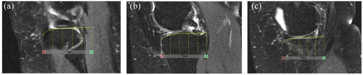 Comparative validation of the knee inflammation MRI scoring system and the MRI osteoarthritis knee score for semi-quantitative assessment of bone marrow lesions and synovitis-effusion in osteoarthritis: an international multi-reader exercise.