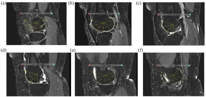 Comparative validation of the knee inflammation MRI scoring system and the MRI osteoarthritis knee score for semi-quantitative assessment of bone marrow lesions and synovitis-effusion in osteoarthritis: an international multi-reader exercise.