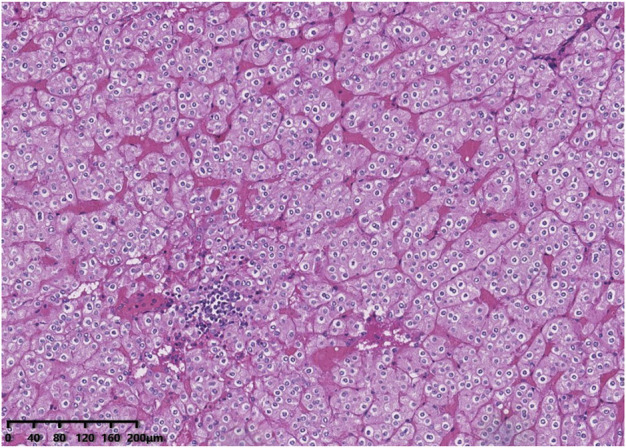 Low-grade oncocytic tumour (LOT) of the kidney is characterised by GATA3 positivity, FOXI1 negativity and mTOR pathway mutations.