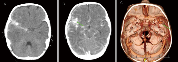 Ruptured Middle Cerebral Artery Aneurysm in an Infant: Case Report and Literature Review.