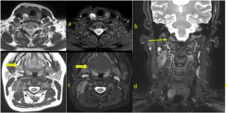 Recurrent Aggressive Fibromatosis Coexisting With Papillary Carcinoma Thyroid - Case Report.