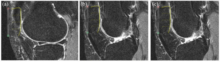 Comparative validation of the knee inflammation MRI scoring system and the MRI osteoarthritis knee score for semi-quantitative assessment of bone marrow lesions and synovitis-effusion in osteoarthritis: an international multi-reader exercise.